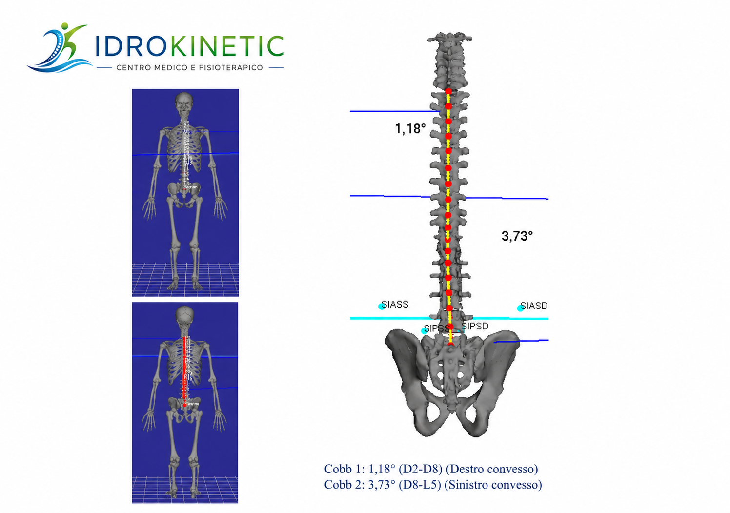 Report Analisi Posturale 3D B.A.K. Idrokinetic con misurazione angoli Cobb e punti di repere pelvici